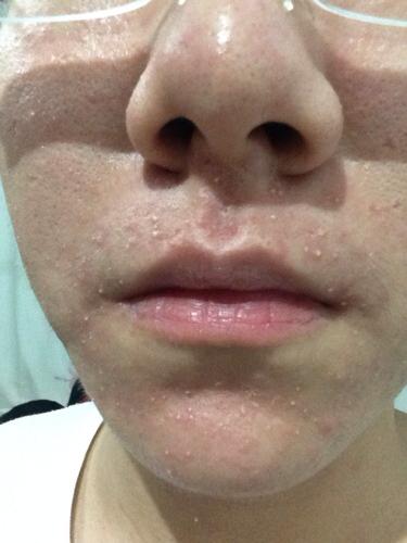 问:脸上长了很多这样的小脓包怎么办?