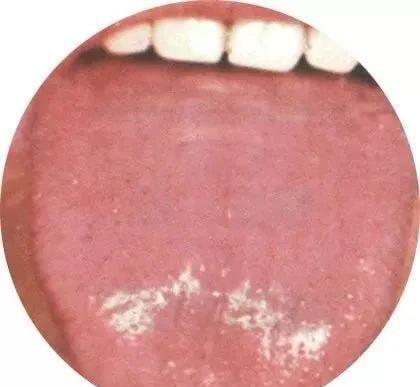 舌头中间是食管,胃的反映区,如果此区域存在裂纹,可能预示胃癌风险高