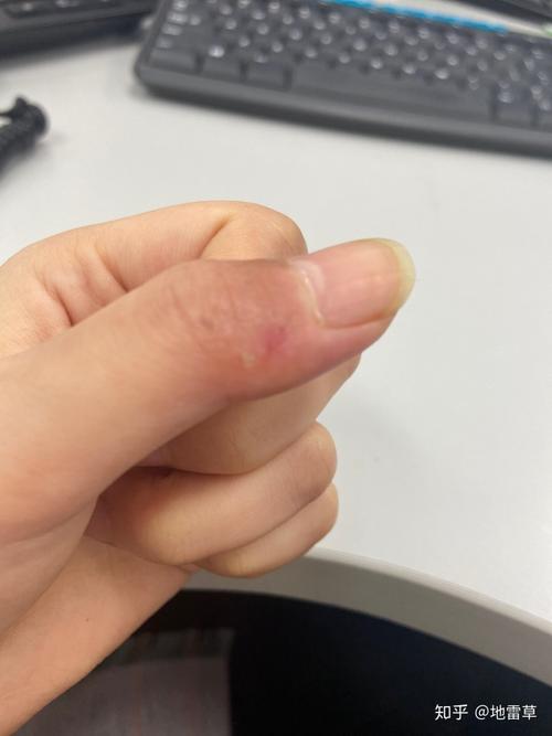 手指血管瘤化脓性肉芽肿继续更新