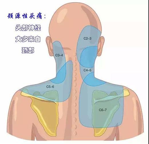 颈源性头痛一种易被忽略的头痛
