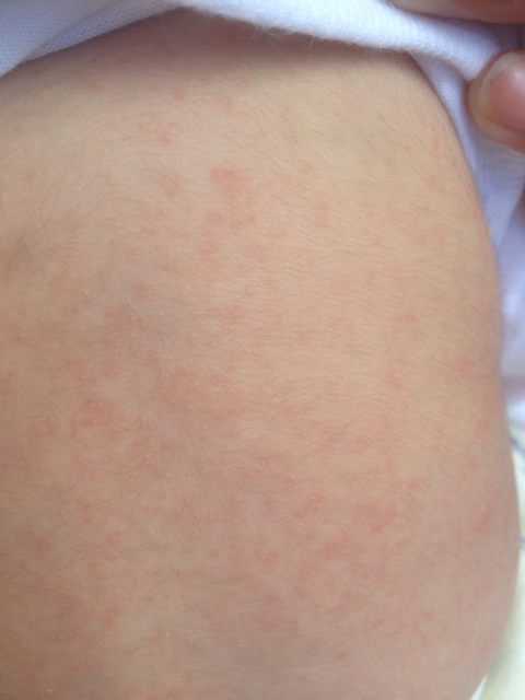 孩子后背起满了密密麻麻的点