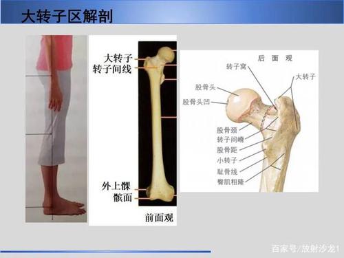 股骨大转子疼痛综合征mr特征