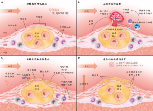 《新英格兰医学杂志》综述:动脉粥样硬化斑块 斑块糜烂是在纤维帽未