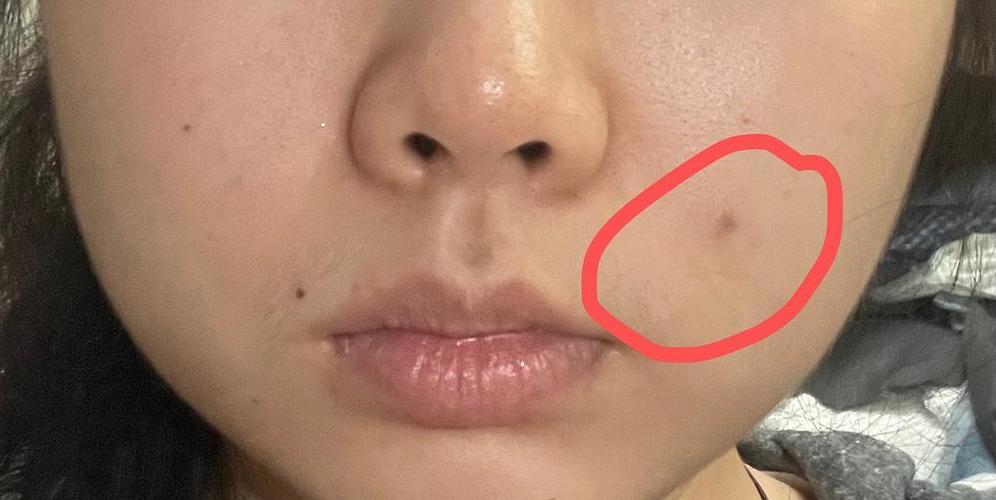 面部血管瘤求助(已就医)