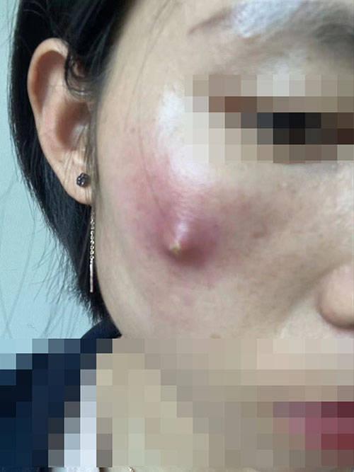 如果不小心长了疖痈,不要过于紧张,采取正确的处理
