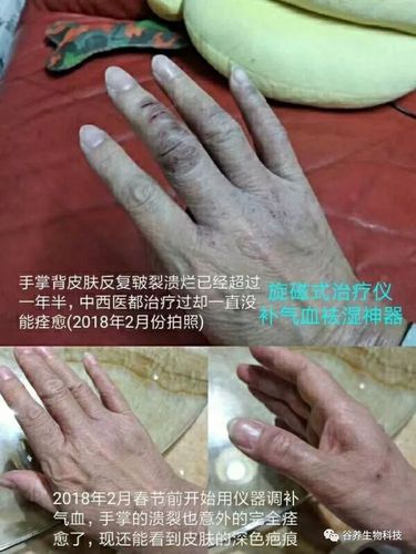 旋磁式糖尿病治疗仪效果案例分享9_256上网导航