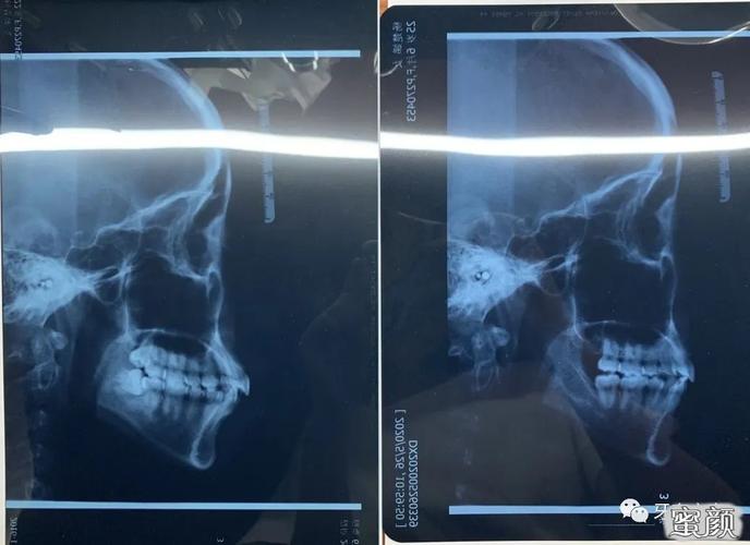 美然牙齿不齐骨性龅牙拔了8颗牙矫正3年半我终于从一个龅牙妹变成一个