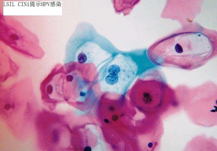 早期宫颈癌或癌前病变是否有什么征兆?