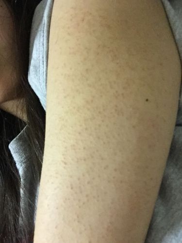 图分别为小腿和手臂 鸡皮肤 是遗传的一直都是这样的