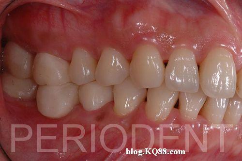 陈柏坚医师发表牙周治疗及手术之病例