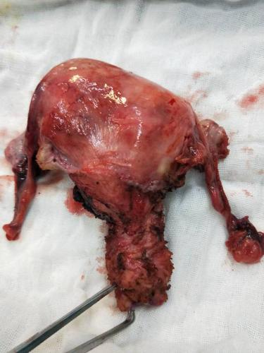 成功完成腹腔镜下全子宫双附件切除术一例