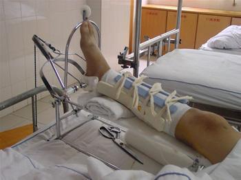 骨折了,我就跟其他同学约好去看他,到他家就看见他裹着石膏躺在床上