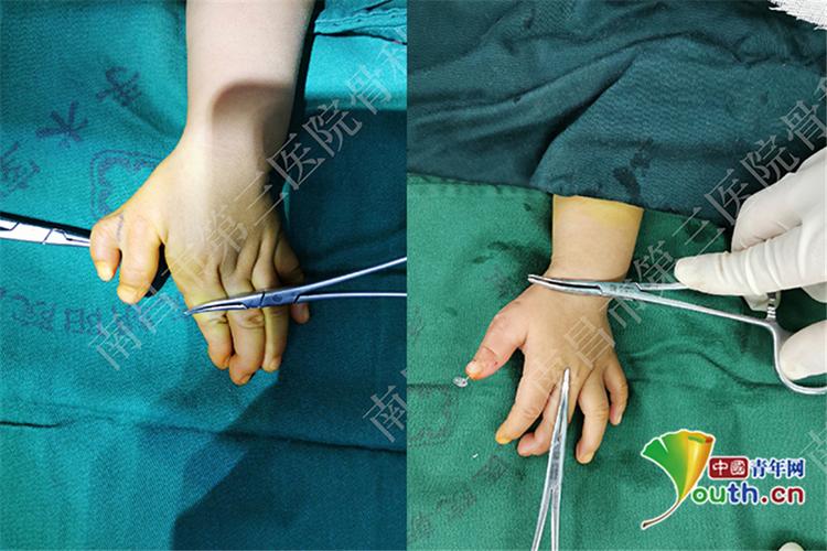 左手天生六指 南昌一名男童手术矫形成功修复