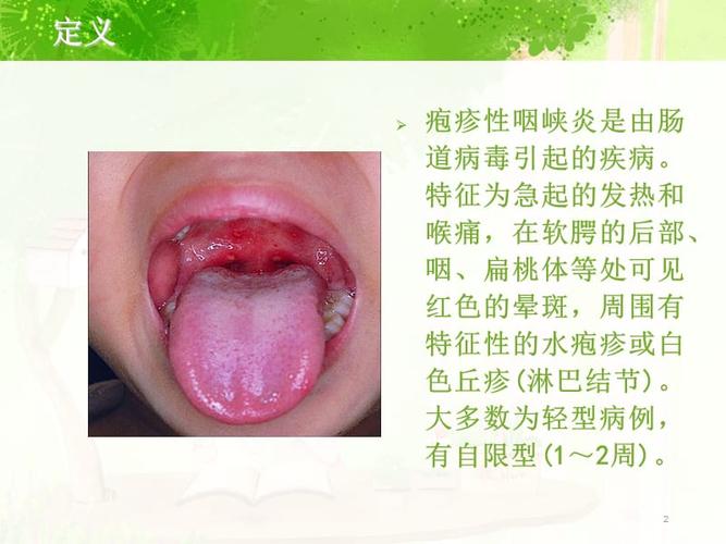 疱疹性咽峡炎的护理ppt演示幻灯片