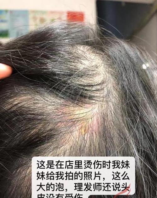 丹阳一女子烫发被烫伤要索赔,店家竟表示