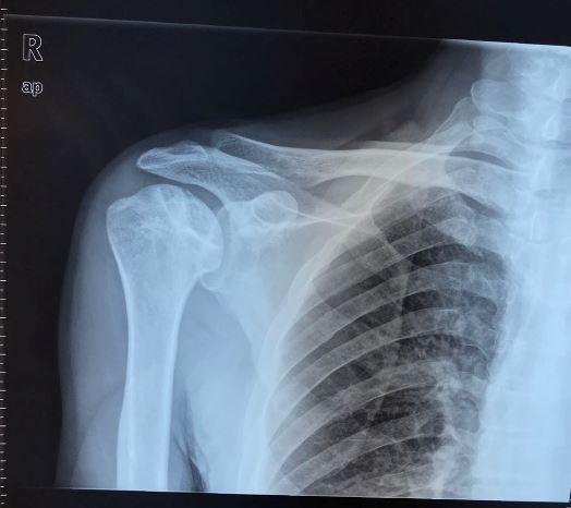 肩关节肱骨头坏死按坏死范围分成哪几类?