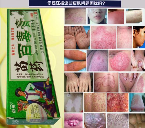 成人清疹湿痒皮肤止痒膏顽固肌肤阴囊肛周止痒等修复无激素湿清霜