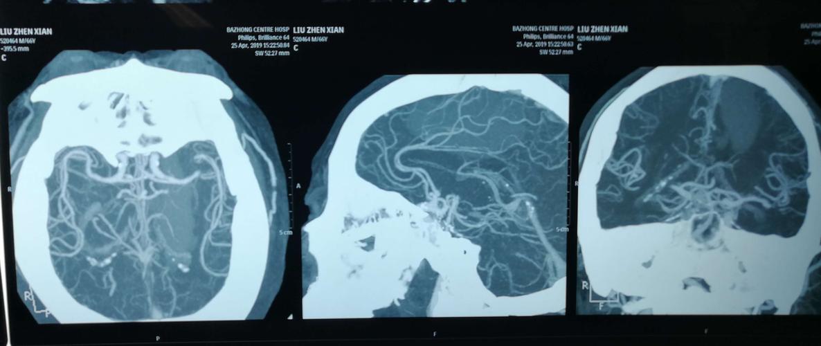 轴位矢状位冠位示血肿和血管关系