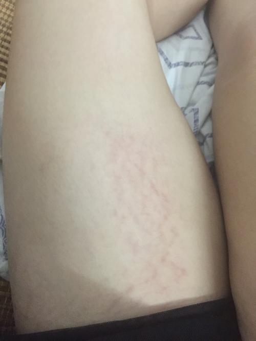 我这是怎么了,这是肥胖纹还是什么?大腿肚子都有,有人可以解疑一下