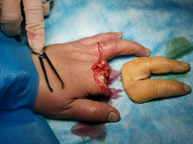 双手多指离断 郑州市第十五人民医院 骨三科