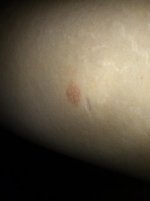 各位大神看看小弟身上怎么了出的一块块的癣这是皮癣吗