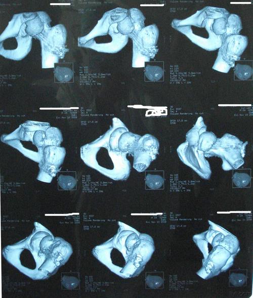 股骨颈骨折 or 股骨头骨折