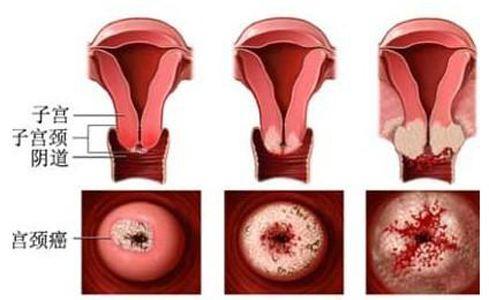 早期宫颈癌常无明显症状和体征,宫颈