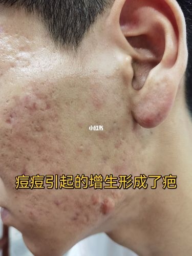 满脸痘坑真的难受_痘坑_祛疤_脓包痘痘_疤痕_觅尚美甲