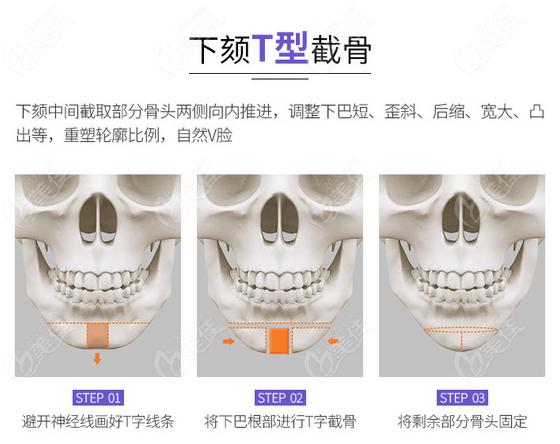 颏成型手术和下巴t型截骨手术图解