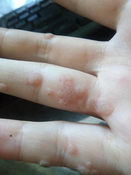 想问一下这是什么皮肤病啊?手上长了好多这个肉球