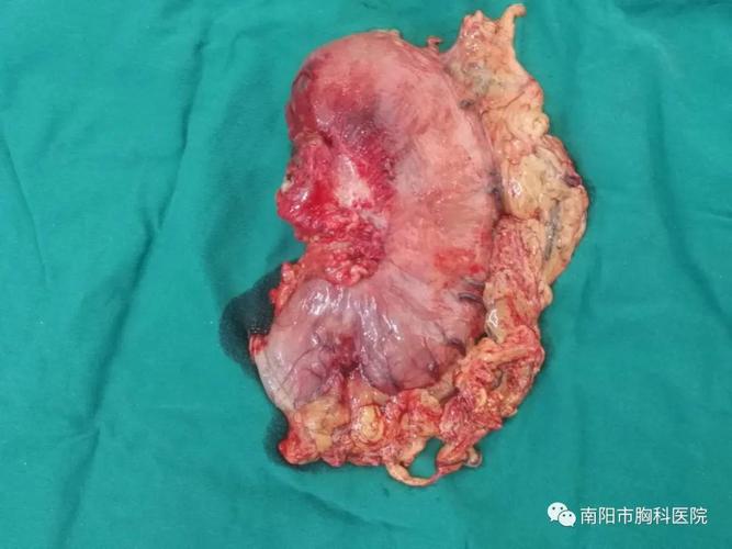 64岁腔镜下胃癌根治术