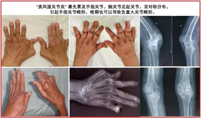 五种常见的关节炎你真的清楚吗