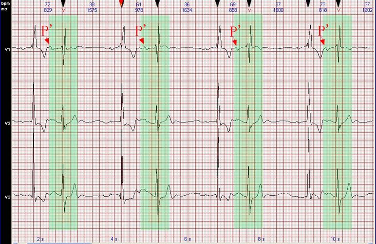 心电图病例分析:房性早搏伴室内差异性传导呈二联律