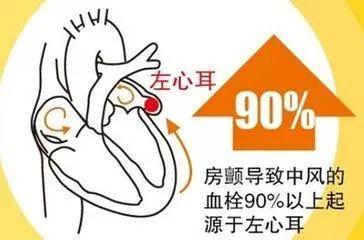 左心耳封堵术是怎么预防脑梗的?效果怎么样?