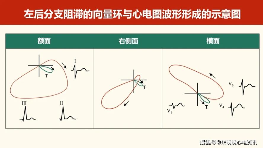 一文掌握心电向量:从基本原理到临床应用
