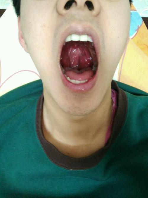 无副作用,不过没有手术治疗的快,但是能够保留正常的扁桃体组织,有