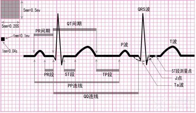 虫哥说图 | 冠心病心电图研判 4 步法(附视频)