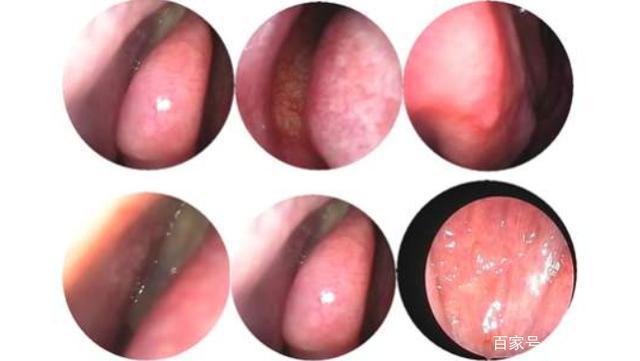 什么是鼻息肉鼻息肉的典型症状有哪些