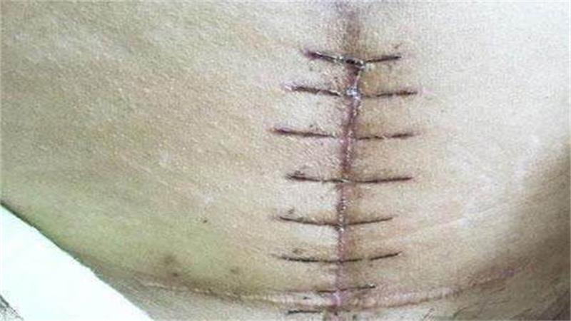 剖腹产正常疤痕图,疤痕真的那么可怕吗?