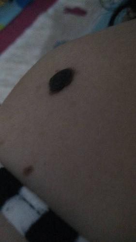 女人右肩上有棵大痣能取掉吗?