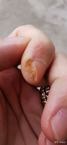 六年甲周疣hpv治愈2020