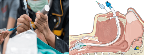 "保护性通气技术"——如何让你在麻醉过程更安全_插管