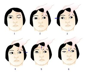 针灸治疗动眼神经麻痹