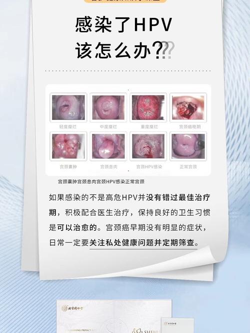 宫颈癌预防_宫颈癌_hpv_医疗健康_医疗健康其他