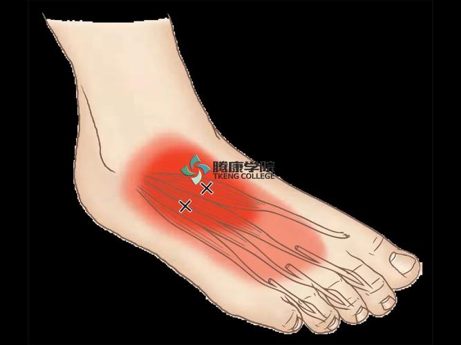 短伸肌扳机点引起的疼痛与趾长伸肌,胫骨前肌以及第三腓骨肌扳机点的
