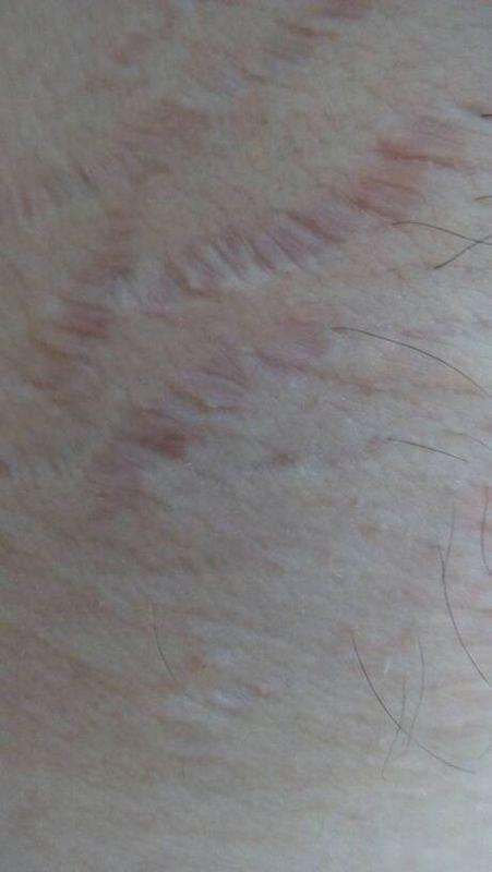 大腿肥胖纹 (第1页)