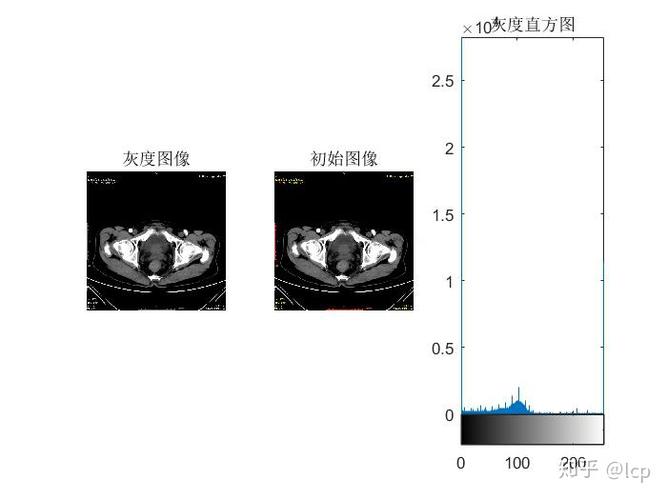 图1-2 1002号病人灰度直方图