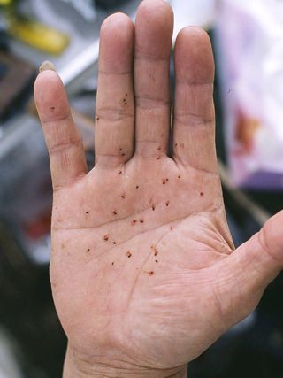 一种黑色小虫子咬人特别痒,不知道这叫什么虫