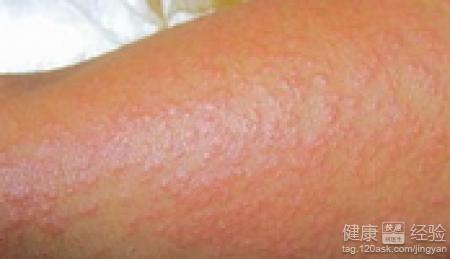 日光性皮炎的常见偏方疗法