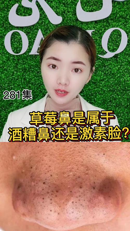 草莓鼻还是属于酒糟鼻还是激素脸